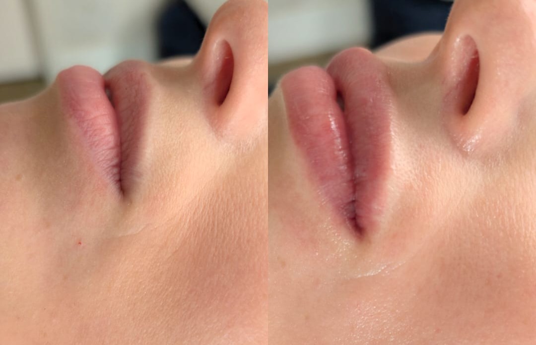 Before and After 11